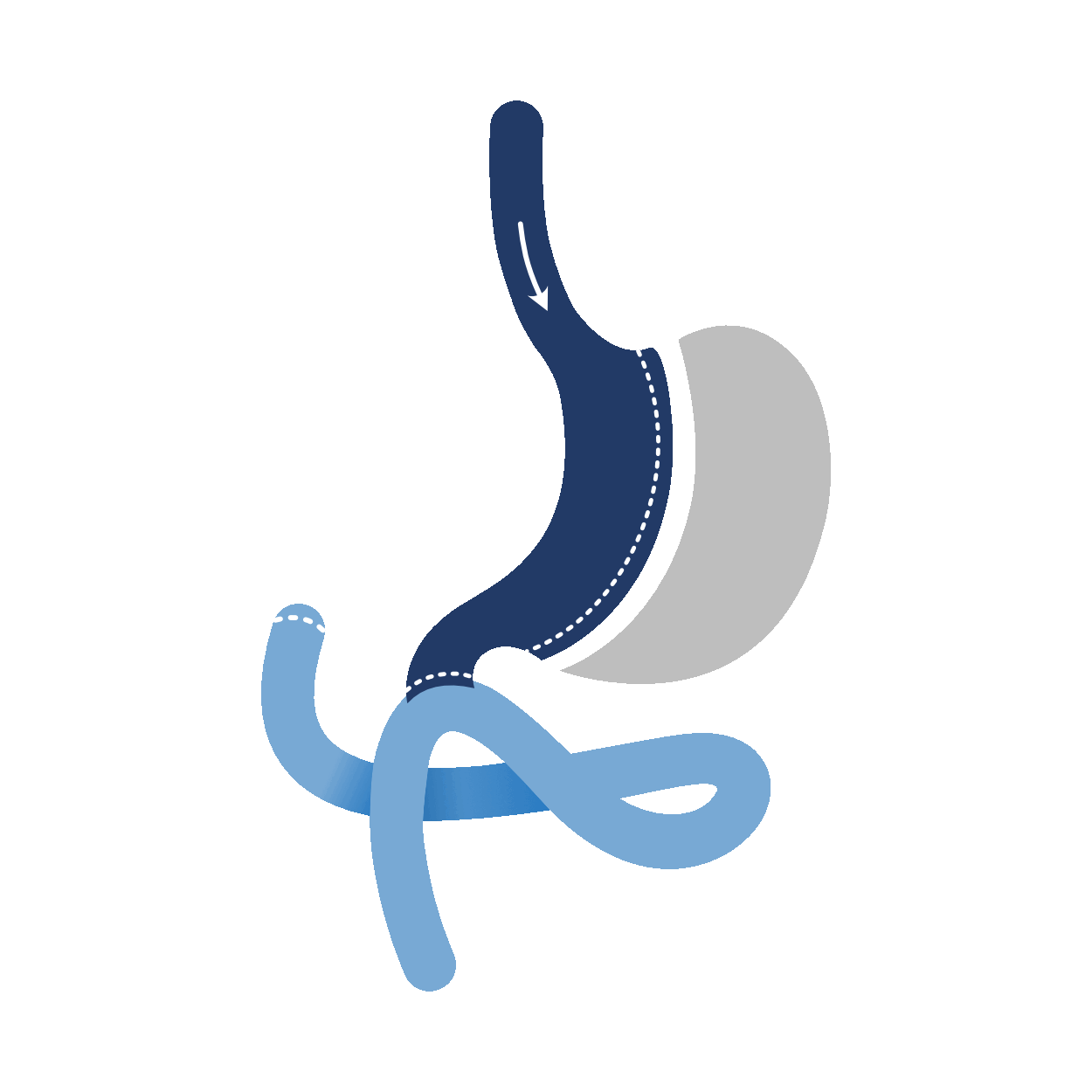 SADI-S SURGERY
