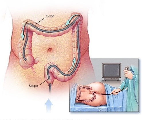 Colonoscopy