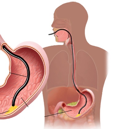 Gastric Therapy Procedure